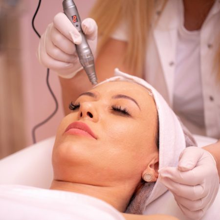 Microneedling